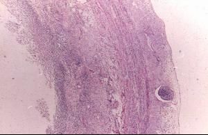 結腸充氣試驗 結腸充氣試驗