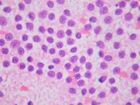 急性淋巴細胞性白血病