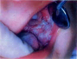 壞死性齦口炎 壞死性齦口炎