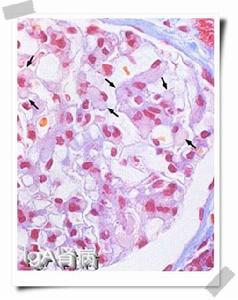 IgA腎病Lee分級 IgA腎病Lee分級