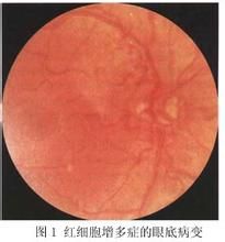 紅細胞增多症眼底 紅細胞增多症眼底