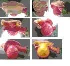 外陰卵黃囊瘤 外陰卵黃囊瘤