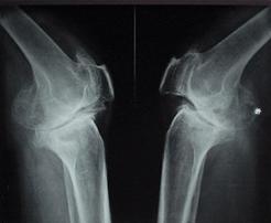 膝蓋骨關節炎 膝蓋骨關節炎