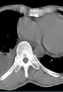 包裹性胸腔積液