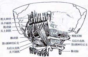 環枕筋膜攣縮型頸椎病