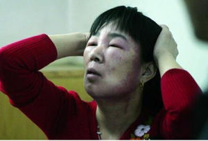 面部水腫 面部水腫