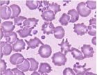 皺縮紅細胞：周邊呈鋸齒狀排列緊密，大小不等，外端較尖。增多見於細胞脫水。