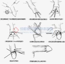 包皮手術