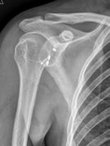 肩關節脫位 肩關節脫位