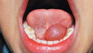 舌下囊腫