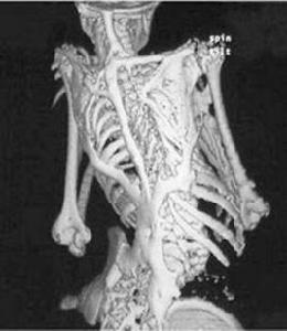 進行性肌肉骨化症 進行性肌肉骨化症