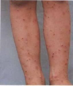 尖銳濕疣早期症狀網 尖銳濕疣早期症狀網