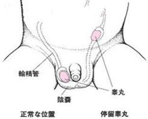 小兒隱睪症 小兒隱睪症