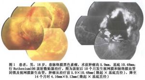 放射性視網膜病變