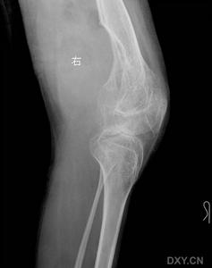 血友病性關節炎 血友病性關節炎