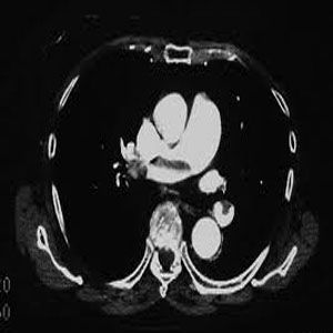 呼吸性酸中毒 呼吸性酸中毒