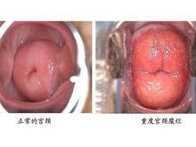 排卵期白帶帶血