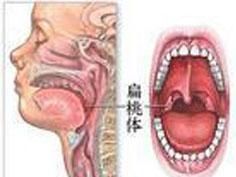 扁桃體癌 扁桃體癌