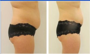 GLM熱立塑效果圖