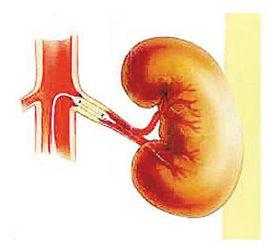 腎性高血壓病 腎性高血壓病