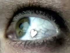 眼球穿孔傷 眼球穿孔傷