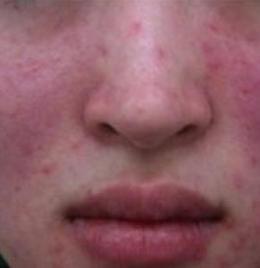 皮膚過敏 皮膚過敏