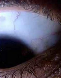 圓錐角膜 圓錐角膜