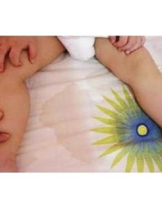 小兒遺尿 小兒遺尿