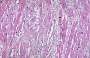 系統性澱粉樣變性