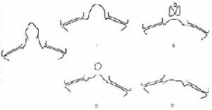齒狀突發育畸形