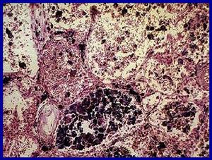 肺泡蛋白沉著症