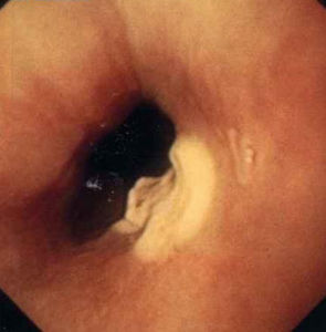 食管平滑肌瘤 食管平滑肌瘤