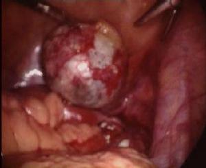 卵巢未成熟畸胎瘤