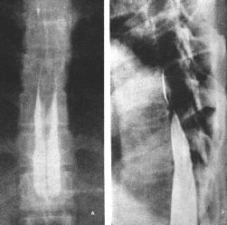 原發性椎管內腫瘤