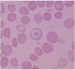 靶形紅細胞：增多見於地中海貧血。