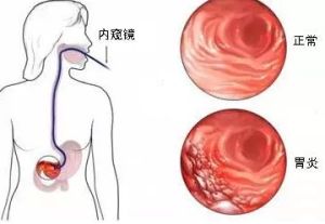 慢性淺表性胃炎