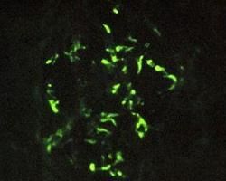 系膜增生性腎小球腎炎 系膜增生性腎小球腎炎