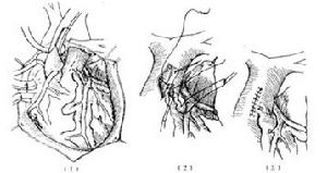 冠狀動脈終止異常