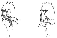 先天性主動脈瓣上狹窄