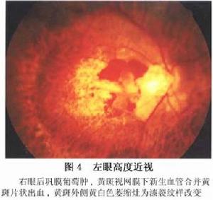 變性近視的脈絡膜萎縮