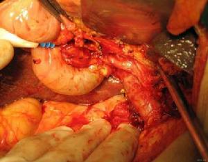 眶內海綿狀血管瘤