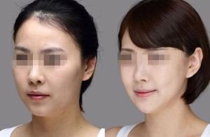 玻尿酸墊下巴 玻尿酸墊下巴
