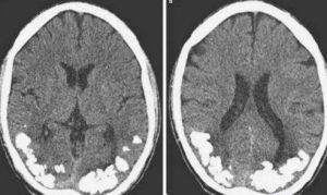 邦納綜合症 邦納綜合症