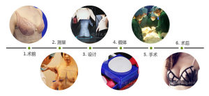 內鏡極速恢復隆胸