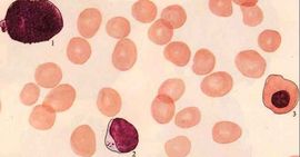 急性再生障礙性貧血 急性再生障礙性貧血