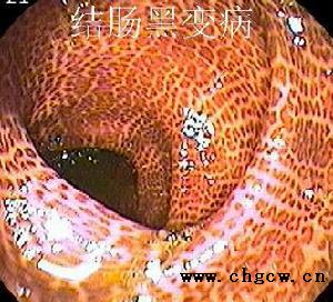 結、直腸黑變病 結、直腸黑變病