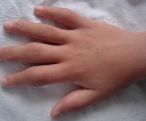 肥大性骨關節病 肥大性骨關節病