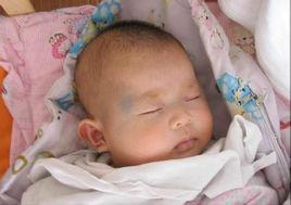 嬰兒太田痣 嬰兒太田痣