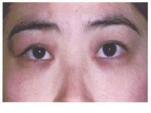 淚腺肉樣瘤病 淚腺肉樣瘤病