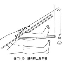 股骨髁上骨牽引